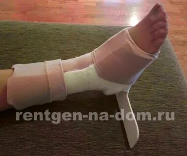 Гипс сапожок при переломе