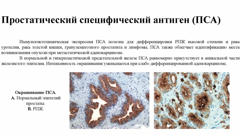 Пса общий простатический специфический. Простатический антиген (пса). Простатический антиген общий норма. Определение простат-специфического антигена пса в крови. Пса при раке предстательной