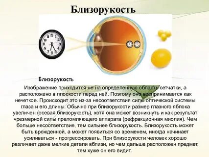 Для миопии характерно