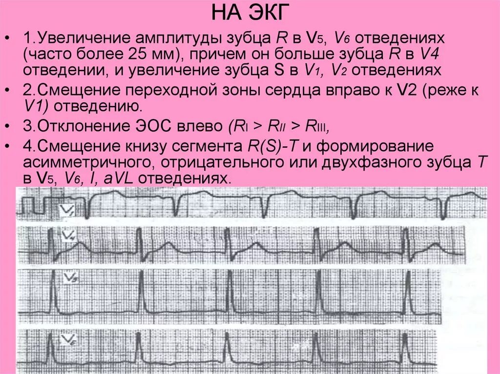 Зубец r1 и r на ЭКГ. Зубцы на ЭКГ S В v1. Зубец р на ЭКГ v1-v6. Зубцы на ЭКГ В отведении v2.