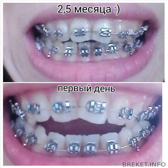 Первый день после установки брекетов. Эффект брекетов по месяцам. брекеты результат по месяцам.