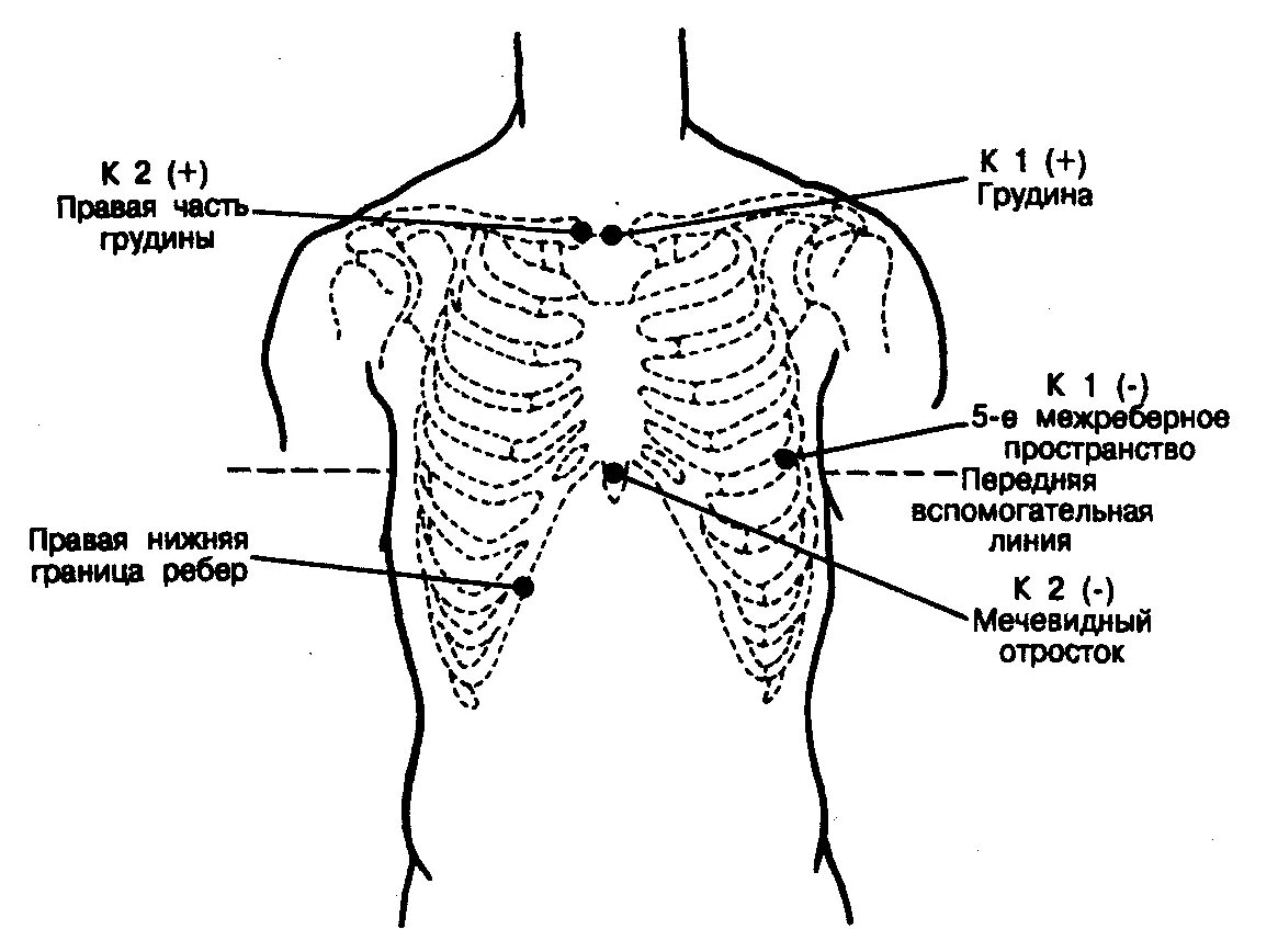 Боли под правой грудиной. Холтер схема установки электродов. Боль в нижней части грудной клетки посередине спереди. Схема установки электродов холтера. Хольер схема электродов.