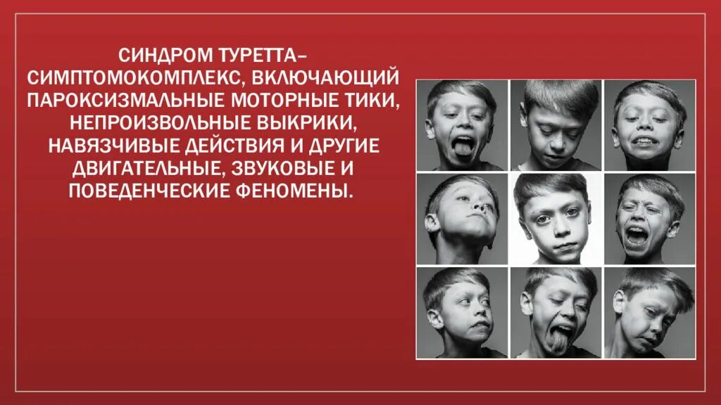 Синдром т. Синдром туретта. тур синдром. болезнь туретта. синдром жиля туретта.