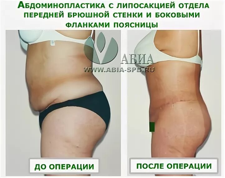 Вес после липосакции