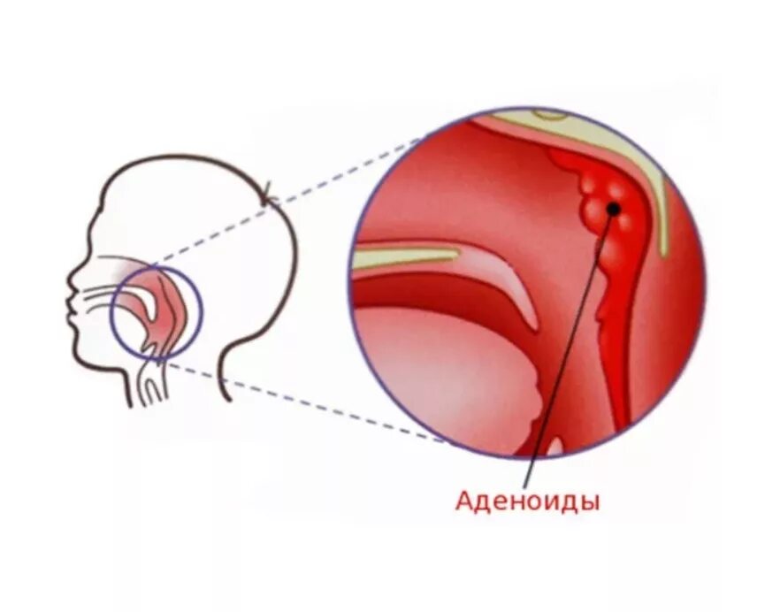 Аденоиды признаки