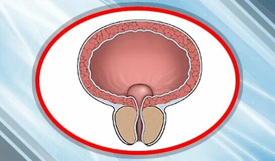 Хроническая простата аденома. 107. Аденома предстательной железы.. Аденома мочевого пузыря. Подпузырная форма аденомы предстательной железы.