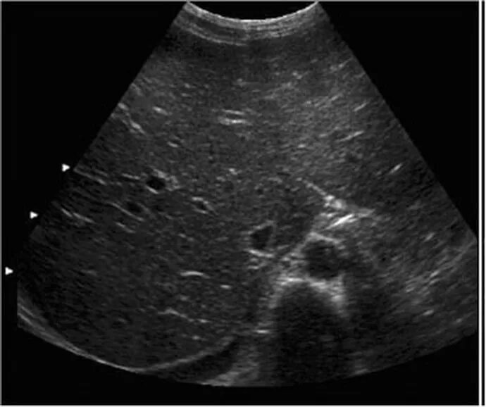 Кальцинат в печени на узи. Перипортальный фиброз УЗИ. Мелкоочаговый фиброз печени УЗИ.