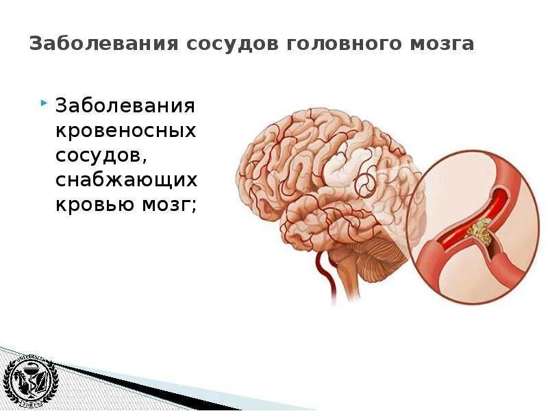 Помочь сосудам головы. Заболевания сосудов головного мозга. Сосудистые нарушения головного мозга. Заболевания сосудов головного мозга названия. Поражение артерий головного мозга.