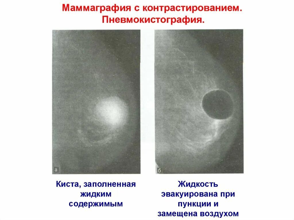 Уплотнения в молочных железах. Болезненное уплотнение в молочной железе. Пневмокистография молочной железы. Нажать на сосок