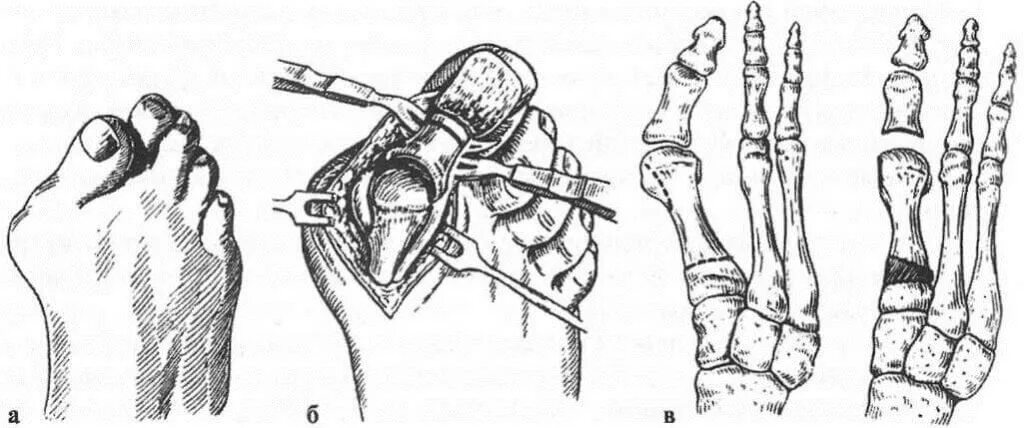 Операция деформации пальцев стопы. Операция шеде при hallux valgus. операция аддуктотомии при hallux valgus. остеотомия стопы халюс вальгус.