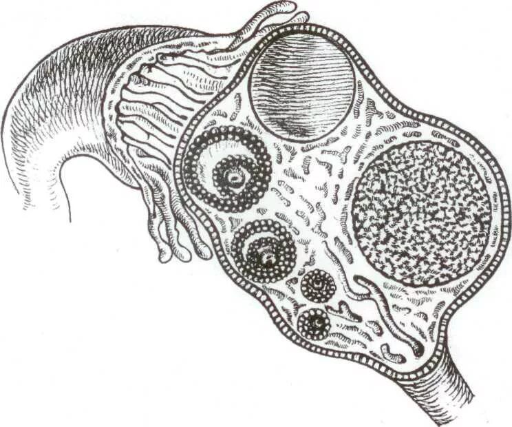 Везикулярная привеска яичника. Утолщенная капсула яичника. Внешнее строение яичника.