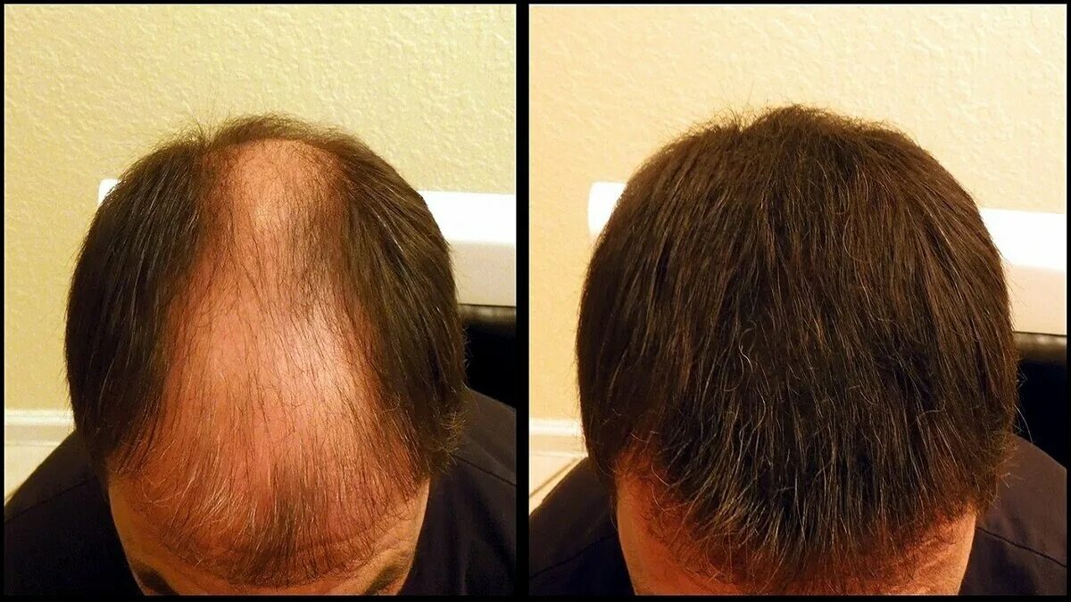 Волосы дают мужчине. Накладка на лысину для мужчин. Мезотерапия волос мужчин. Мужское облысение. Прически для лысеющих с затылка.