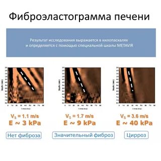 Подготовка к фиброэластометрия печени