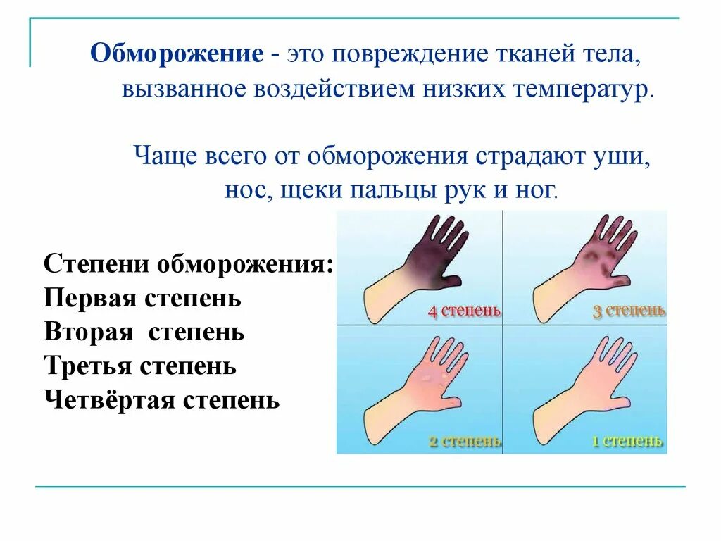 Отморожения презентация. Отморожение руки степени. Обморожение рук первой степени.