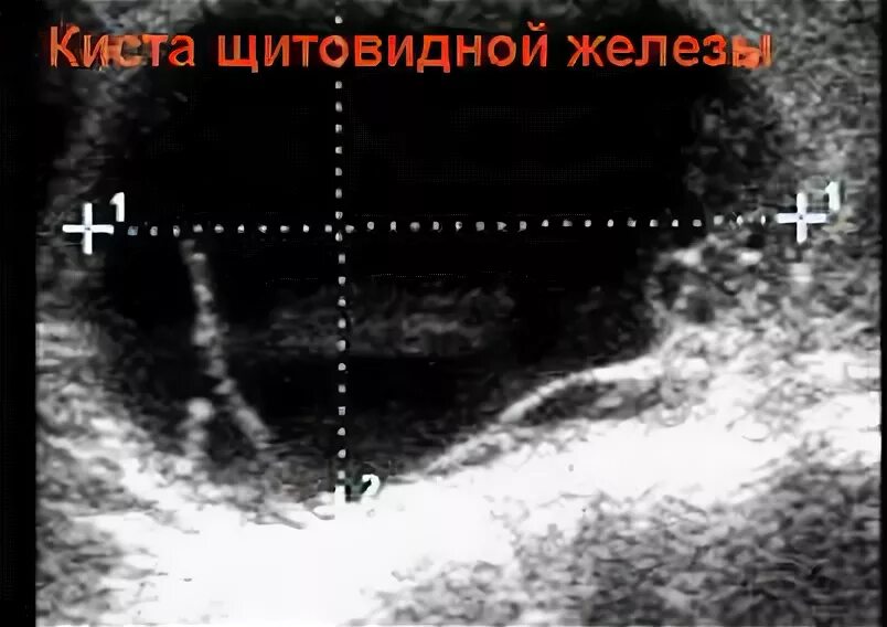 Киста щитовидной у мужчин. Киста щитовидной железы на УЗИ. Коллоидная киста щитовидной. Коллоидные кисты щитовидной железы. Киста щитовидки правой доли.