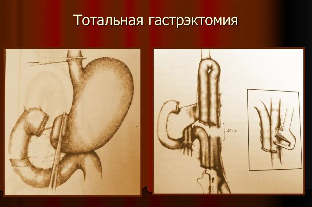 Тотальная гастрэктомия желудка. Гастроэктомия это. Резекция желудка хирургия операция. Гастроэктомия это. Гастроэктомия желудка операция ход операции.