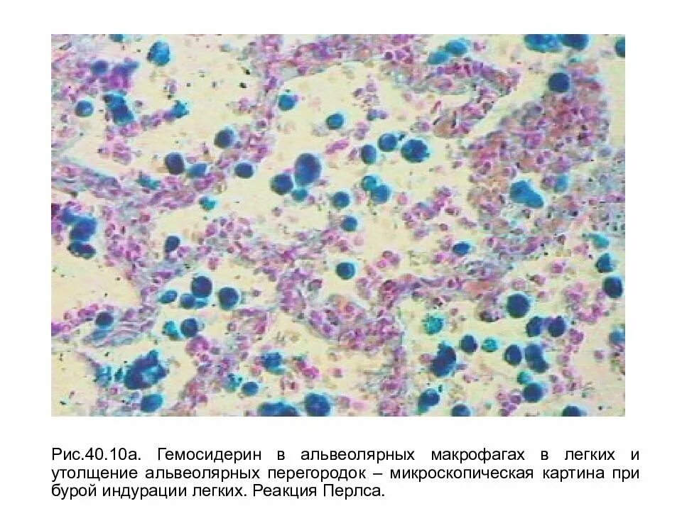 Цианотическая индурация селезенки макропрепарат. Бурая индурация легких патанатомия. Бурая индурация легкого макропрепарат. Венозное полнокровие патологическая анатомия. Гемосидероз легкого патологическая анатомия.