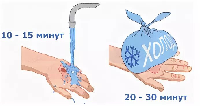 Охлаждение при ожогах водой.