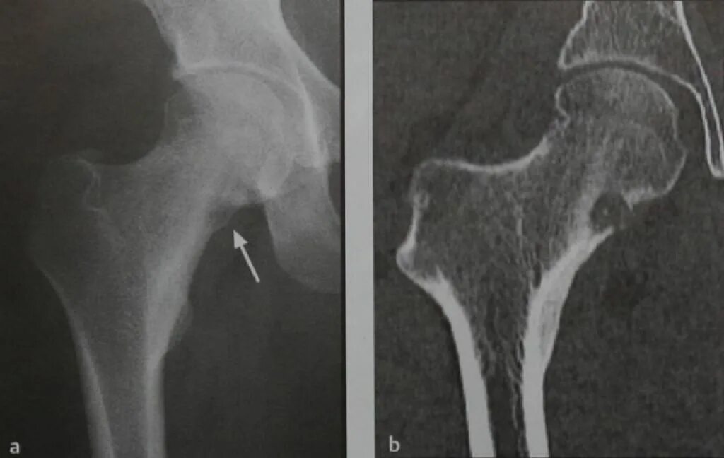 Остеома шейки бедренной кости. Остеома шейки бедренной кости кт. Остеома кости тазобедренного сустава. Остеоид остеома плечевой кости. Отек шейки бедра