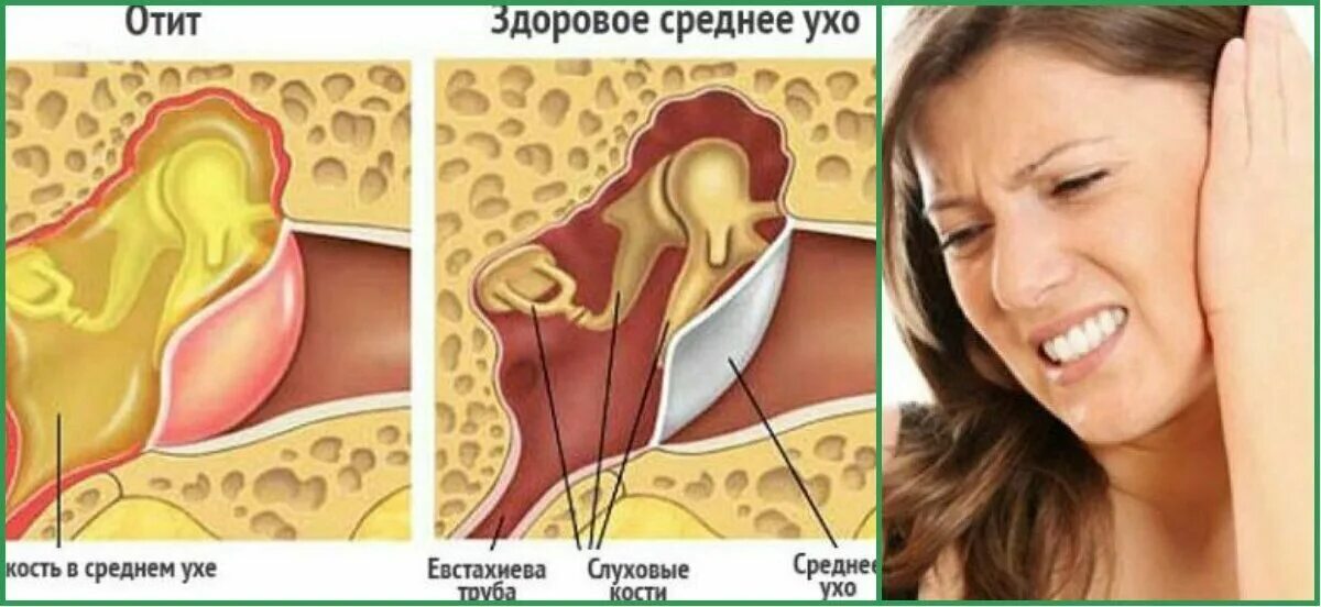 Отомикоз серная пробка. Можно ли при отите наушники