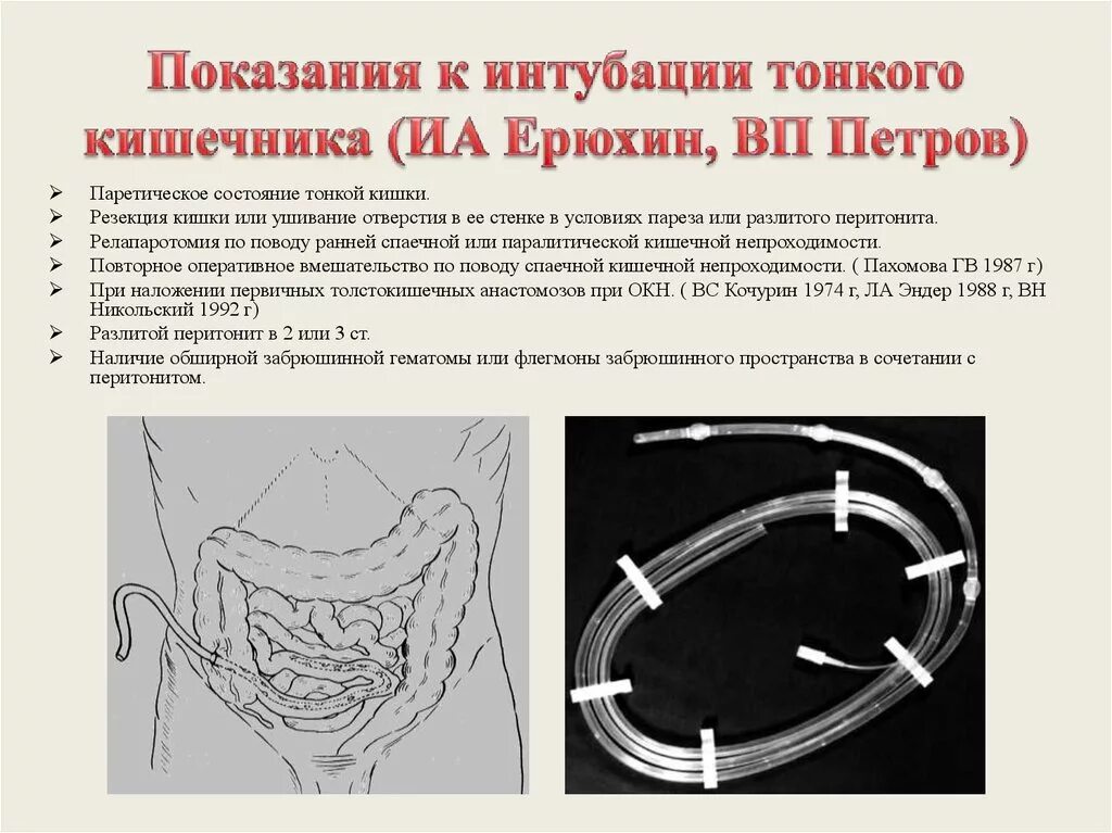 Что такое санация кишечника. Зонд назоинтестинальный для интубации. Назоинтестинальная интубация кишечника. Трансназальная интубация кишечника. Трансректальная интубация кишечника.