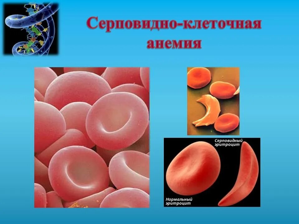Эритроциты при серповидно клеточной анемии. Серповидноклеточная анемия изменчивость. Серповидно клеточная анемия. Серповидноклеточная анемия мутация. Серповидноклеточная анемия симптомы.