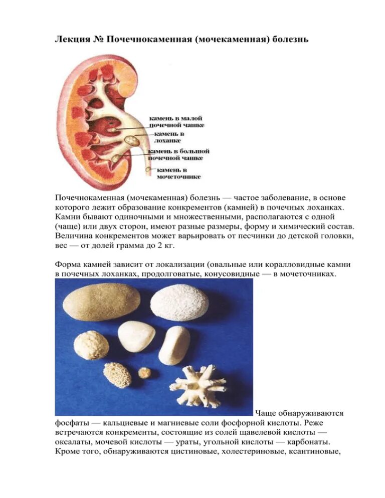Мочекаменная и Почечнокаменная болезнь. Мочекаменная болезнь конкременты. Классификация камней при мочекаменной болезни.