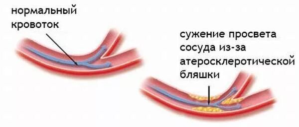 Атеросклеротическая бляшка. Сужение просвета сосудов. Сужение сосудов руки