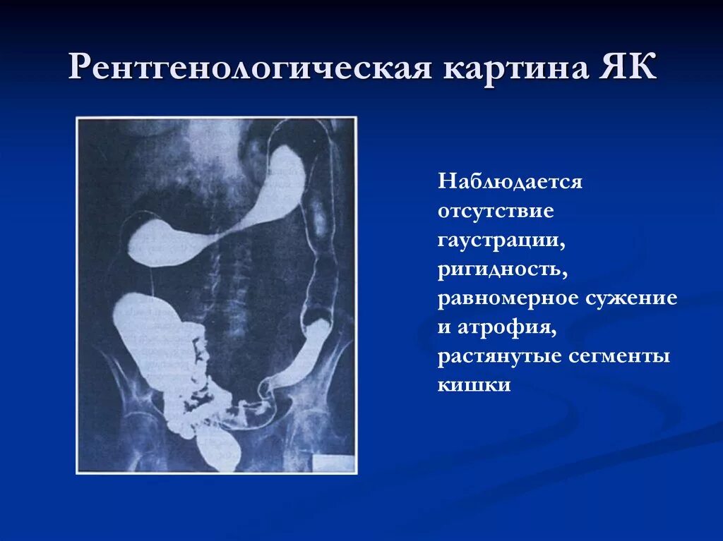 Гаустрация это. Гаустрации толстого кишечника. гаустрация толстой кишки выражена. рентгенологическая картина колита.