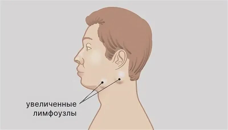 Увеличение лимфатических узлов причины