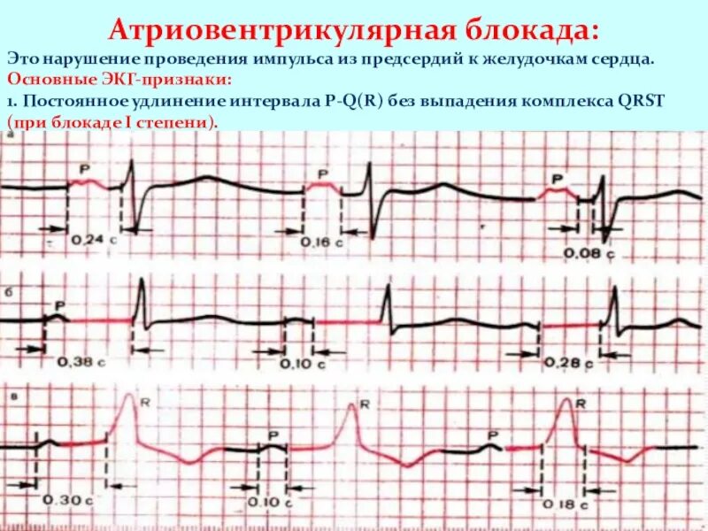Нарушение проводимости предсердий. Степени атриовентрикулярной блокады на экг. атриовентрикулярная блокада 1 на экг. критерии ав блокады 1 степени на экг. нарушение проводимости ав блокады.