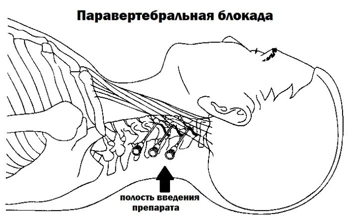 Блокада в шею. Шейная паравертебральная блокада методика. Паравертебральная блокада грудного отдела позвоночника техника. Паравертебральная блокада шейного отдела техника.