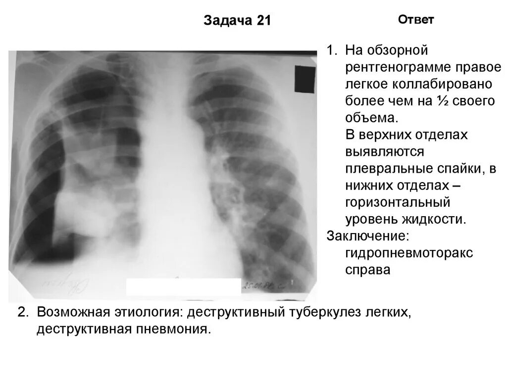 Туберкулез плевры рентген. Спайка в легком рентгене. Пневмогидроторакс рентген описание.