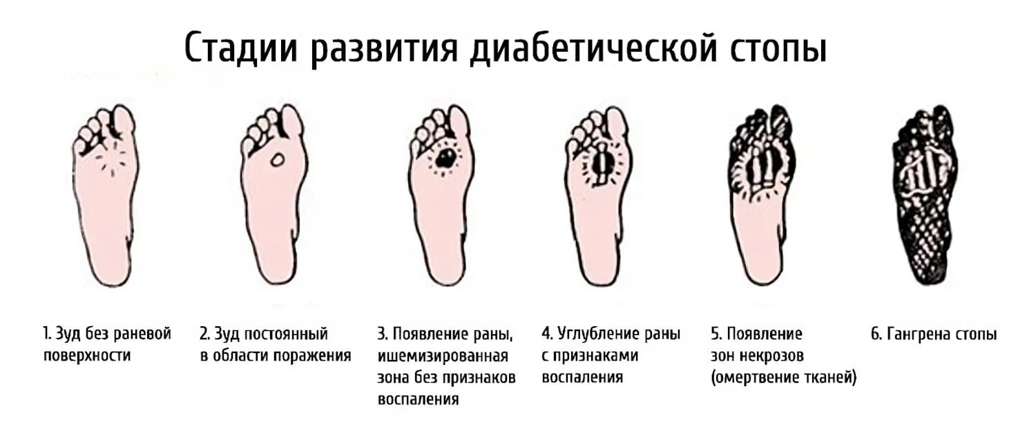 Поражение первой степени. Диабетическая стопа гангрена стопы. Язвы при синдроме диабетической стопы. Гангрена пальцев стопы диабетическая. Начальные симптомы диабетической стопы.