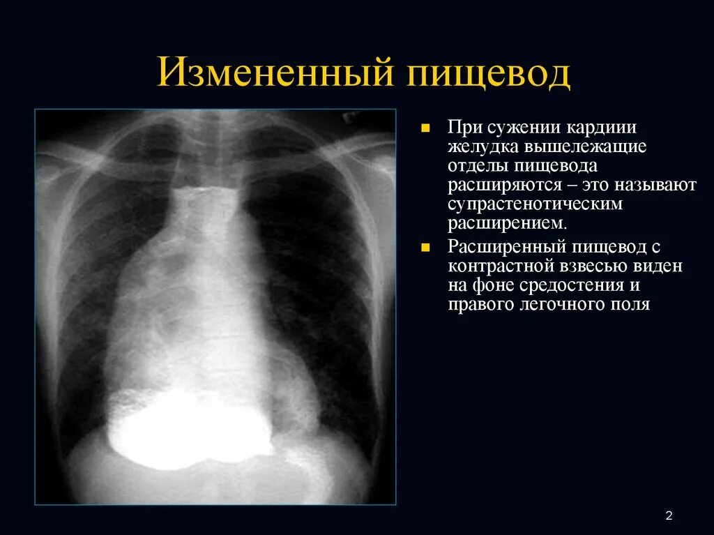 Киста пищевода. Расширение средостения. Супрастенотическое расширение пищевода. Средостение анатомия.