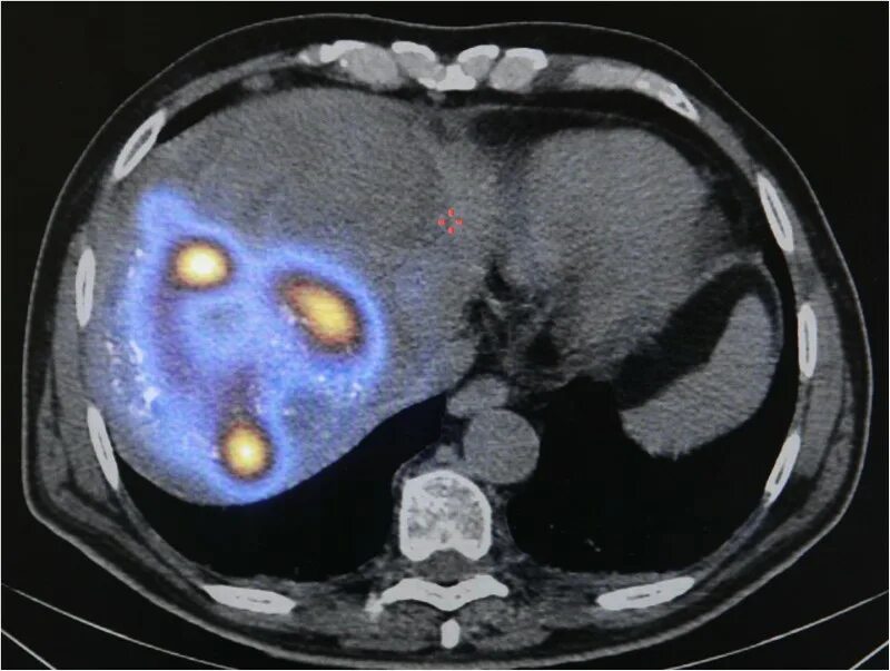 Метастатическое поражение печени. Метастатические опухоли печени. Множественные опухоли. Рак печени 3 стадии