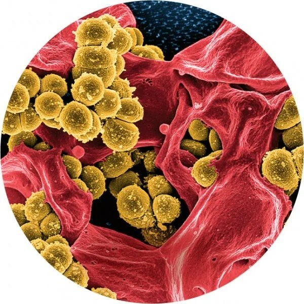 Врачи золотистый стафилококк. Золотистый стафилококк заблвкгтк. Бактерионосители золотистого стафилококк. Стафилококк излечимый. Заражение стафилококком.