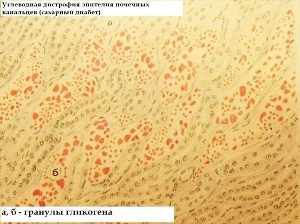 Паренхиматозные углеводные дистрофии. Углеводные дистрофии патанатомия. Углеводная дистрофия почечных канальцев. Углеводная дистрофия эпителия почечных канальцев. Мезенхимальная углеводная дистрофия микропрепарат.