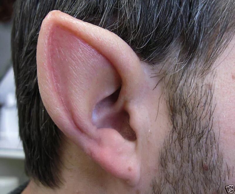 Почему уши острые. Отопластика эльфийские уши.