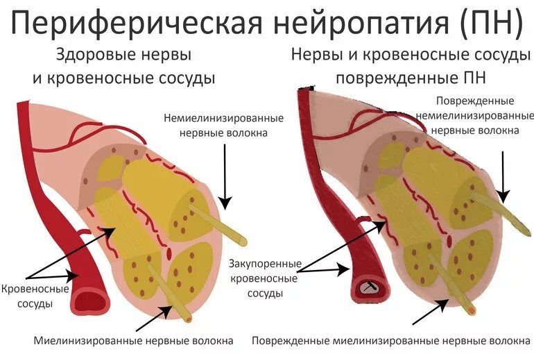 Диабет невропатия. Диабетическая периферическая полинейропатия симптомы. Диабетическая нейропатия нерв. Периферическая сенсорная нейропатия что это такое симптомы. Патогенез симптомов полинейропатии.