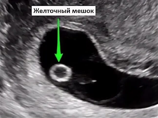 Желточный мешок 3мл. Плодное яйцо 8 мм желточный мешок. 7 недель желточный