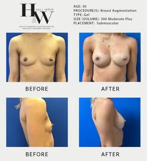 A breast augmentation can increase breast... 