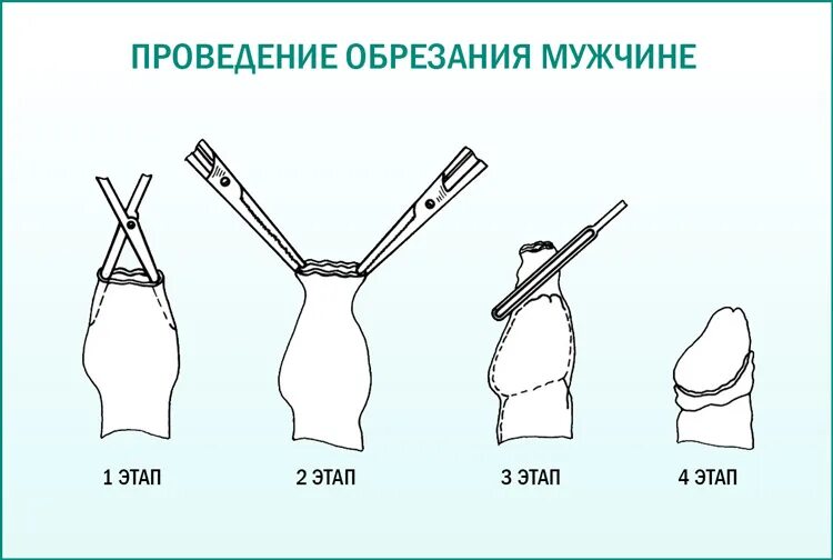 Головка у мужчин. Обрезание схема операции. Схема обрезания крайней плоти. Обрезание у детей схема операции.