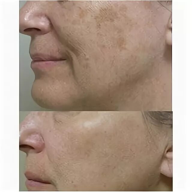 Косплей как скрыть родинки. Как замаскировать пигментные. Макияж с веснушками. Тональный крема от пигментации. Как замаскировать пигментацию на лице с помощью косметики.