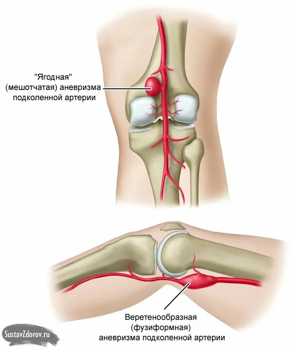 Болит под коленом что это может быть. Аневризм подколенной артерии. Аневризма подколенной вены. Сустав колена болит сбоку внутренней стороны. Аневризма подколенной вены операция.