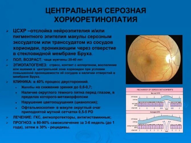 Центральный серозный хориоретинит. Отслойка сетчатки классификация. Серозный хориоретинит глаза. Центральный серозный хориоретинит окт. Жидкость в сетчатке