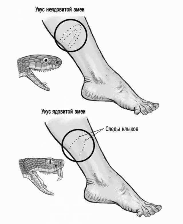 Симптомы укусов змей. Как выглядит укус от змеи.