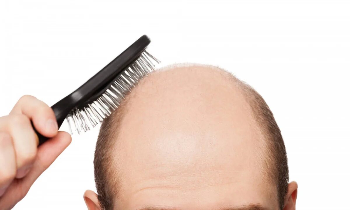 Здоровые мужские волосы. Девушка с расческой. Hair loss prevention. Гиперандрогенная алопеция. Hair loss.