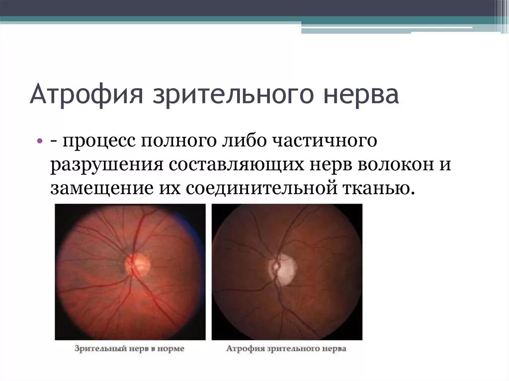 Первичная и вторичная атрофия диска зрительного нерва. Диск зрительного нерва при атрофии. Атрофия дисков зрительных нервов. Частичная атрофия зрительного нерва клиника.