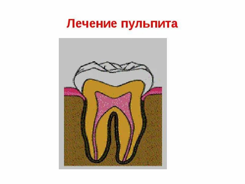 Как вылечить пульпит. Как вылечить пульпит